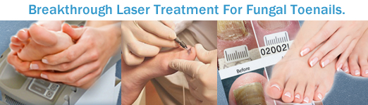 Laser fungal toenail treatement